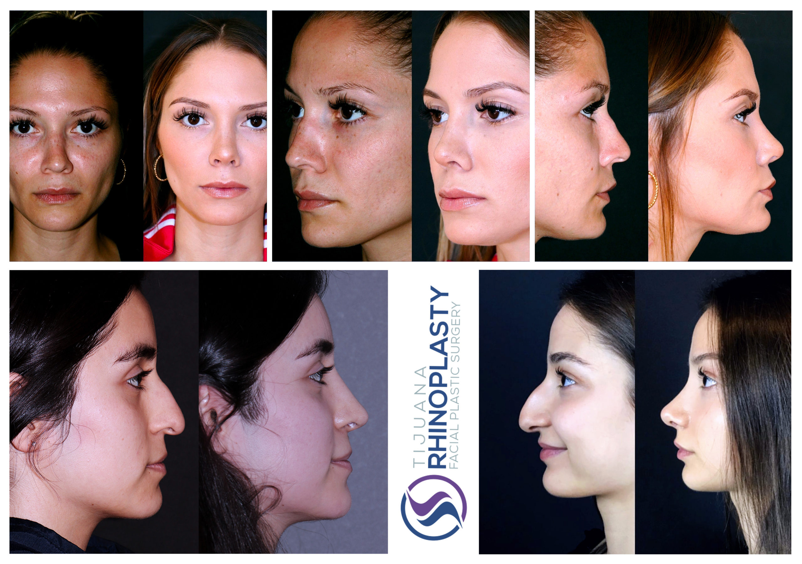 Rinoplastia antes y después. Resultados del Dr. Edgar Eduardo Santos de Rinoplastia Tijuana.